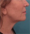 Jowl/Jawline Contouring Kybella Patient #4 After Photo Thumbnail # 4