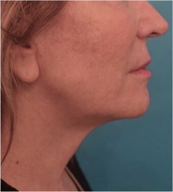 Jowl/Jawline Contouring Kybella Patient #4 After Photo # 4