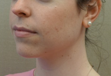 Jowl/Jawline Contouring Kybella Patient #5 After Photo # 4