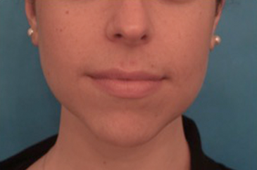 Kybella (Body Contouring) Patient