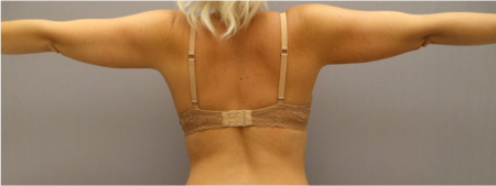 After Image: Body Contouring Kybella Patient #3 -