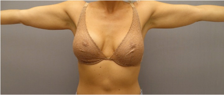 After Image: Body Contouring Kybella Patient #3 - 