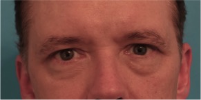 Upper and Lower Eyelid Blepharoplasty #6 Before Photo # 1