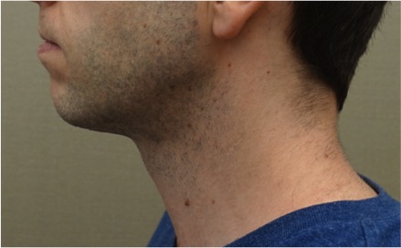 After Image: Male Kybella Patient #2 - 