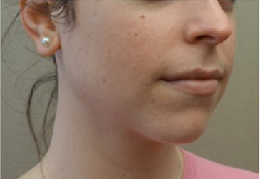 Jowl/Jawline Contouring Kybella Patient #5 After Photo # 8
