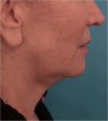 Jowl/Jawline Contouring Kybella Patient #4 Before Photo Thumbnail # 3