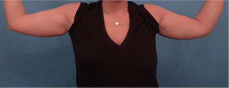 Before Image: Body Contouring Kybella Patient #3 -