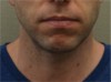 Kybella Patient #7 After Photo Thumbnail # 2