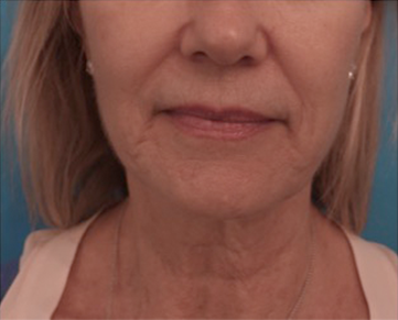 Jowl/Jawline Contouring Kybella Patient #3 After Photo Thumbnail # 2