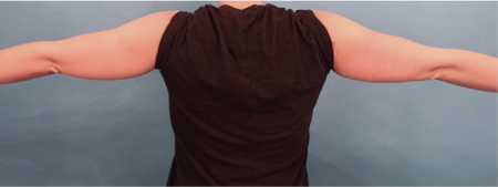 Before Image: Body Contouring Kybella Patient #3 -