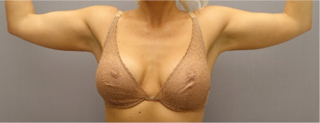 After Image: Body Contouring Kybella Patient #3 -