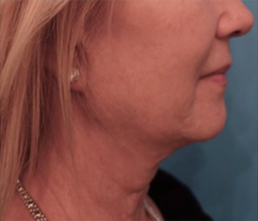 Jowl/Jawline Contouring Kybella Patient #3 Before Photo # 3