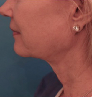 Jowl/Jawline Contouring Kybella Patient #3 After Photo # 6