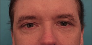 Upper and Lower Eyelid Blepharoplasty #6 After Photo # 2