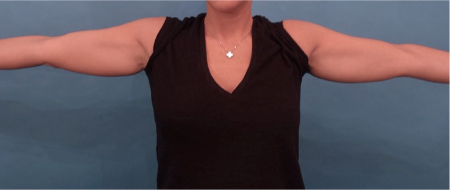Before Image: Body Contouring Kybella Patient #3 - 