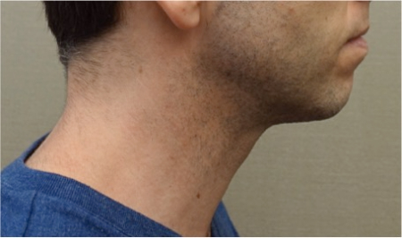 After Image: Male Kybella Patient #2 - 
