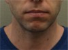 Male Kybella Patient #2 After Photo Thumbnail # 2