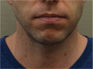 Male Kybella Patient #2 After Photo # 2