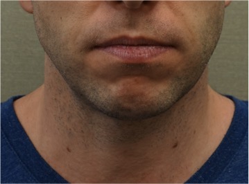 After Image: Male Kybella Patient #2 - 