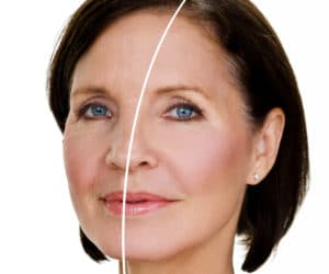 Facelift NYC | Anti-Aging Manhattan