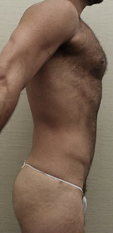 After Image: Male Liposuction Patient #1 -