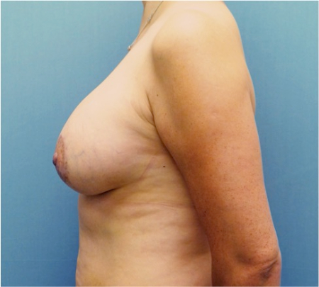 Breast Augmentation (Implants) Patient #18 After Photo # 6