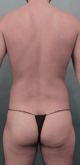 Before Image: Male Liposuction Patient #1 -