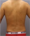 Male Liposuction Patient #3 After Photo Thumbnail # 8