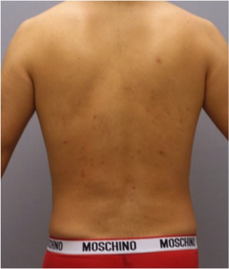 Male Liposuction Patient #3 After Photo # 8