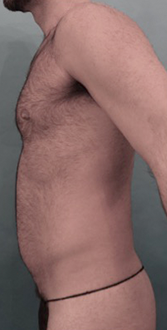 Male Liposuction Patient #1 Before Photo # 9