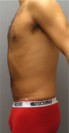 Liposuction Patient #26 After Photo Thumbnail # 6