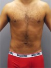 Liposuction Patient