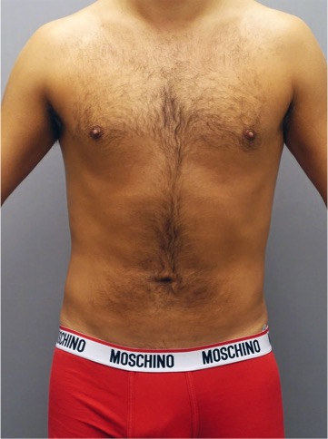 Liposuction Patient #26 After Photo # 2