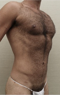 After Image: Male Liposuction Patient #1 -