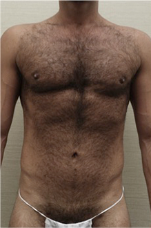 After Image: Male Liposuction Patient #1