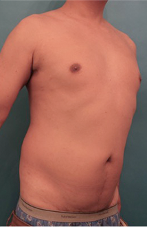 Male Liposuction Patient #5 Before Photo # 7