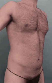 Male Liposuction Patient #1 Before Photo Thumbnail # 3