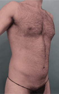 Before Image: Male Liposuction Patient #1 -