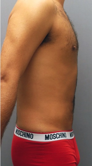 Liposuction Patient #26 After Photo # 4