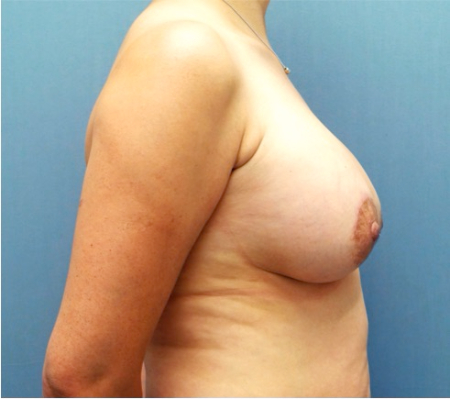 Breast Lift Patient #3 After Photo # 2