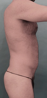 Before Image: Male Liposuction Patient #1 -