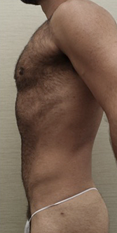After Image: Male Liposuction Patient #1 -