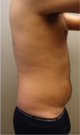 Liposuction Patient #26 Before Photo # 3