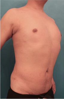 Male Liposuction Patient #5 After Photo # 8