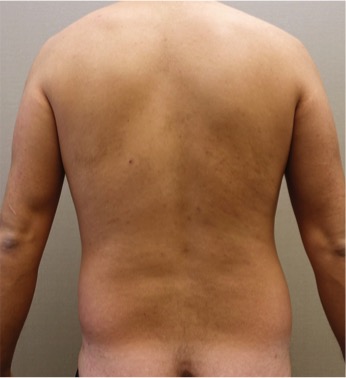 Liposuction Patient #26 Before Photo # 7