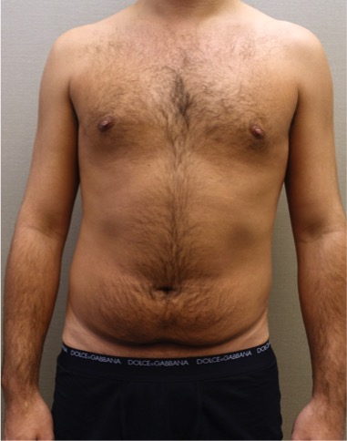 Male Liposuction Patient #3 Before Photo # 1