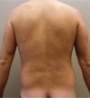 Male Liposuction Patient #3 Before Photo Thumbnail # 7