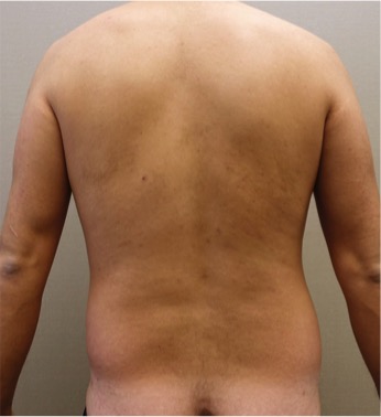 Male Liposuction Patient #3 Before Photo # 7