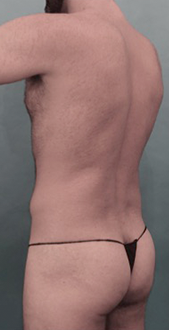 Before Image: Male Liposuction Patient #1 -