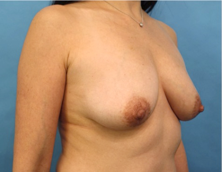 Breast Lift Patient #3 Before Photo # 3